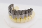 20μM υψηλής ταχύτητας κορωνών ελαφριά θεραπεία εκτυπωτών υποστηριγμάτων ιατρική τρισδιάστατη για την οδοντιατρική